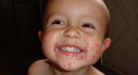 Children prone to hand-foot-and-mouth disease | Caribbean ...